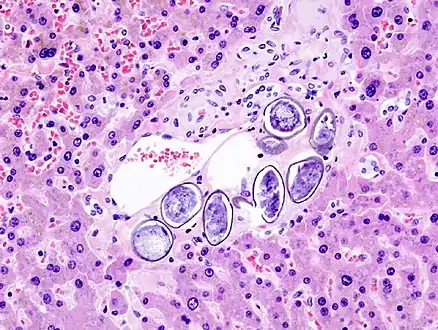 S. japonicum eggs in hepatic portal tract