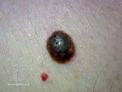 Seborrhoeic keratosis