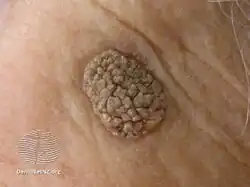 Seborrhoeic keratosis