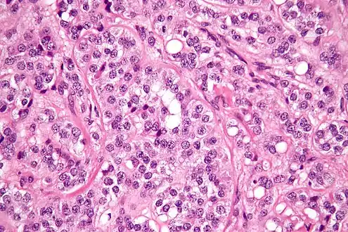 High magnification micrograph of a Sertoli cell tumour. H&E stain.