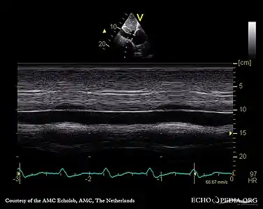 Severe tricuspid regurgitation