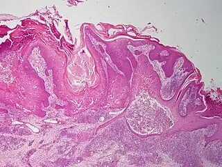 Follicular infundibulum tumor