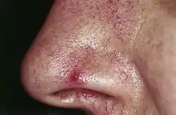 Nevus araneus (spider nevus): in the center of the red lesion a small (1 mm) red papule is visible, surrounded by several distinct radiating vessels. Pressure on the lesion causes it to disappear, however blanching is replaced by rapid refill from the central arteriole when pressure is released.