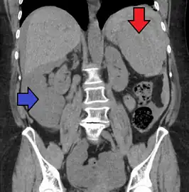 Splenic hematoma resulting in free abdominal blood