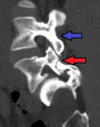 Anterolisthesis L5/S1. Blue arrow normal pars interarticularis. Red arrow is a break in pars interarticularis