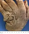 Squamous carcinoma of dorsum of hand