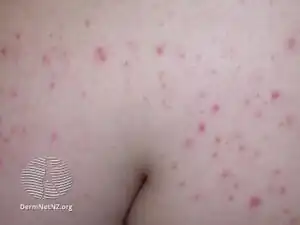 Steroid acne