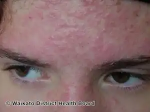 Steroid acne