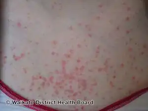 Steroid acne