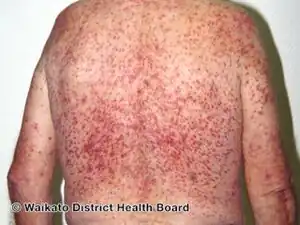 Steroid acne