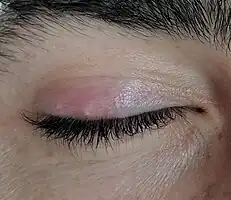 Stye of the upper eyelid