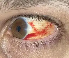 Minor subconjunctival bleed