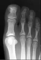 X-ray foot showing subungal exostosis