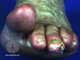 Subungual exostosis 3rd toe