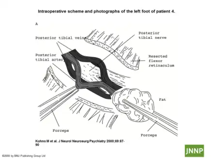 Tarsal tunnel release