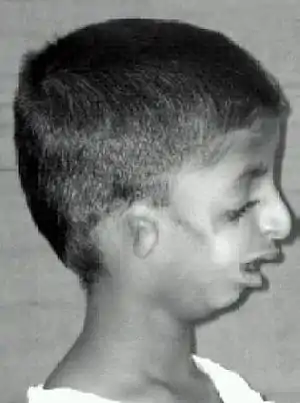 The same child shown from the front above in infobox, now seen from the side, with small ears and a chin that is far back.