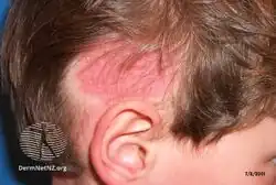 Tinea capitis (head)