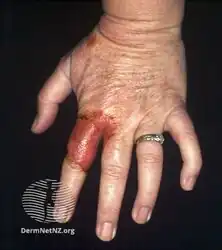 Tinea manuum finger