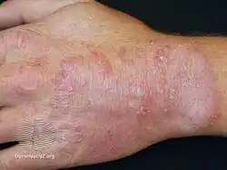 Tinea manuum back of hand