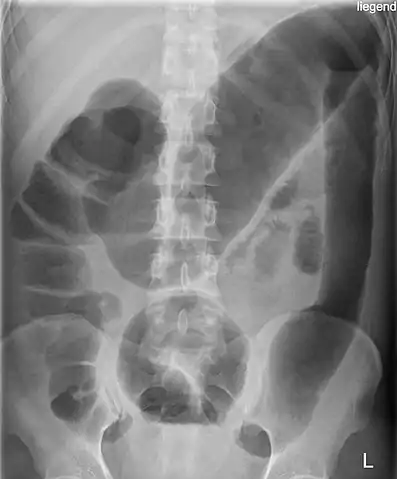 Toxic megacolon in a patient with ulcerative colitis: The patient subsequently underwent a colectomy.