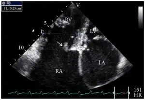 Transthoracic echo: TR (arrow)