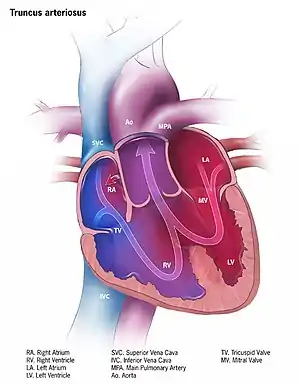 Illustration of truncus arteriosus in a fully formed heart