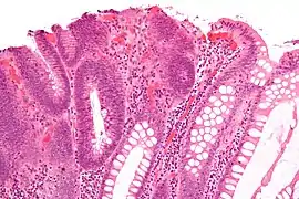 Micrograph of a tubular adenoma, the most common type of dysplastic polyp in the colon.