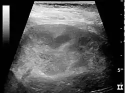 Acute pyelonephritis with increased cortical echogenicity and blurred delineation of the upper pole.