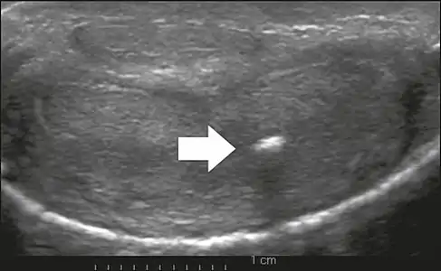 Figure 6: Transverse ultrasound of the penis, in a ventral view, in the middle portion of the penis. Note the echoic image with posterior acoustic shadowing, corresponding to calcification (arrow), in the left corpus cavernosum.