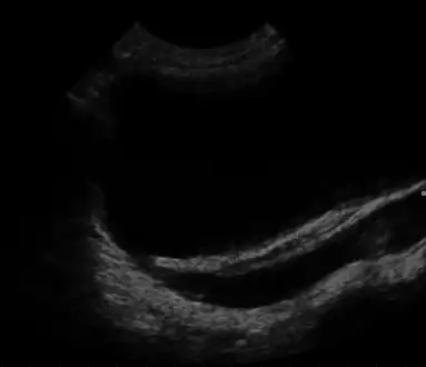 Ultrasound showing  vesicoureteral reflux