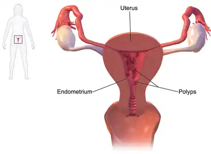 Diagram showing location of polyps