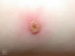 Varicella