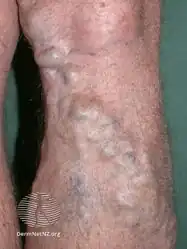 Varicose veins