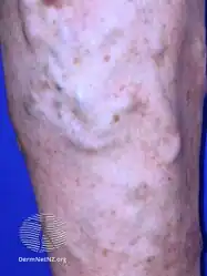 Varicose veins