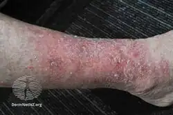 Venous eczema