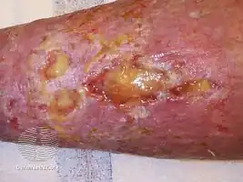 Venous ulcer