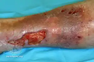 Venous ulcer