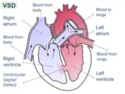 Ventricular septal defect