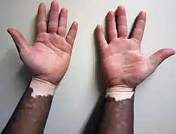 Non-segmental vitiligo on dark skin, hand facing up