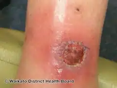 Wound infection -bacterial