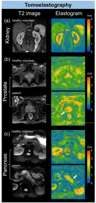 Tomoelastography of Kidney Prostate and Pancreas