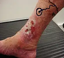 Venous ulcer before surgery