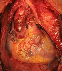 Transplanted heart in the thorax of recipient