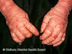 Epidermolytic hyperkeratosis