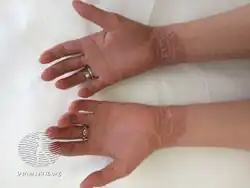 Epidermolytic hyperkeratosis