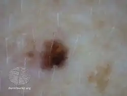 Mole - solitary macule