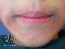 Lip licker's dermatitis