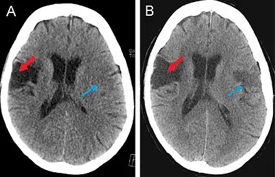 (A) CT scan of a patient with middle cerebral artery stroke illustrating hypodensity areas within the temporal and frontal lobes. (B) CT scan displaying an ischemic stroke bordering the fronto-parietal opercular cortex (red arrow) and a left-sided ichemic lesion of the fronto-parietal opercular cortex (blue arrow).