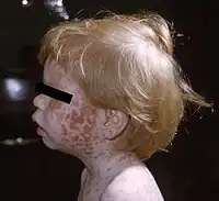Young boy displaying the characteristic maculopapular rash of rubella