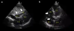 Ultrasound showing the device in the right ventricle